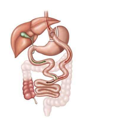 Marseille Obésité gastroplastie bypass